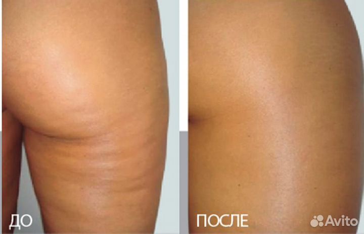 Коррекция фигуры(сфератерапия, RF-лифтинг)