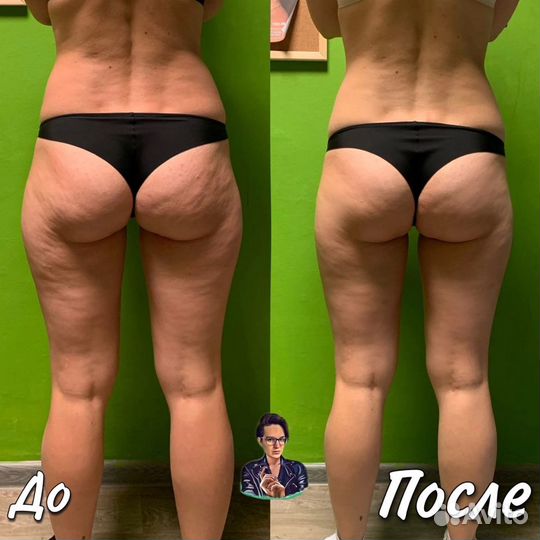 Антицеллюлитный массаж Коррекция фигуры