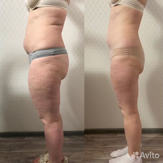 Массаж LPG тело и лицо