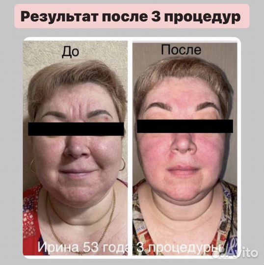 Сплит массаж лица в Ялте