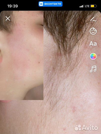 Депиляция воском