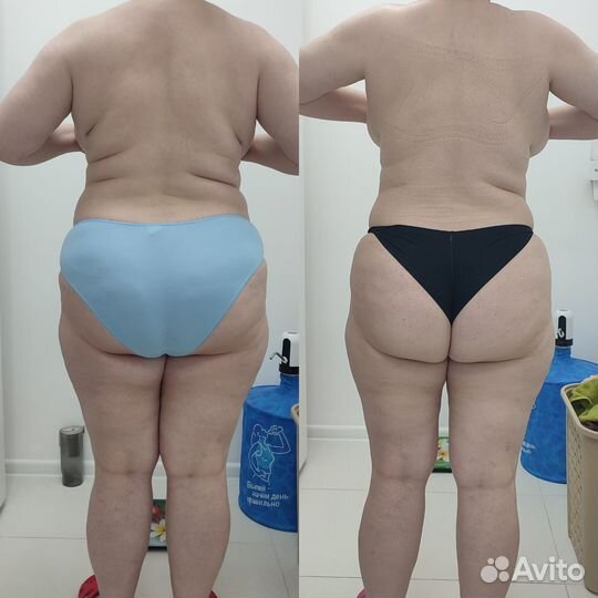 Похудение, Массаж, Аппаратная коррекция фигуры