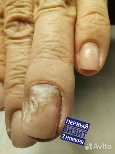 Подологический педикюр