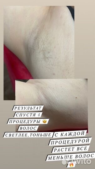 Депиляция воском