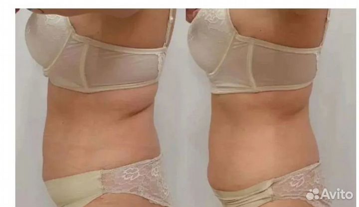 Похудение для мужчин и женщин Криолиполиз Кирове