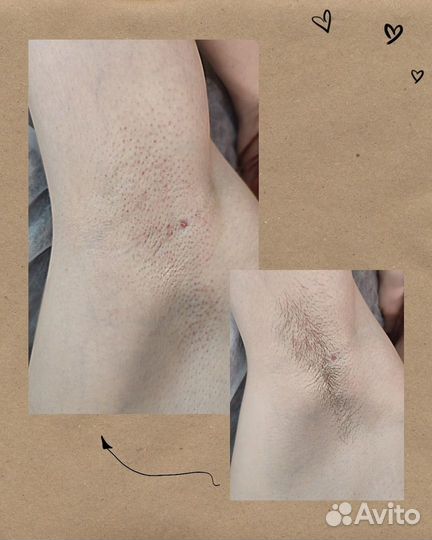 Шугаринг/восковая депиляция Петрозаводск