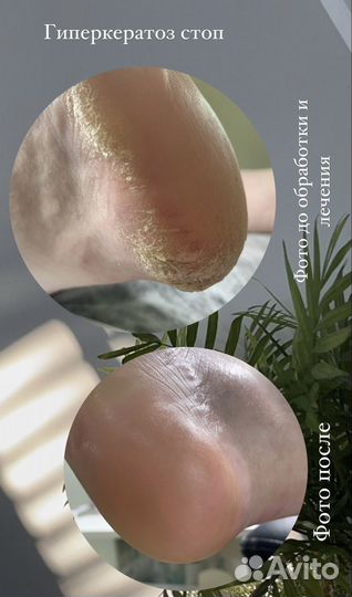 Подология/педикюр