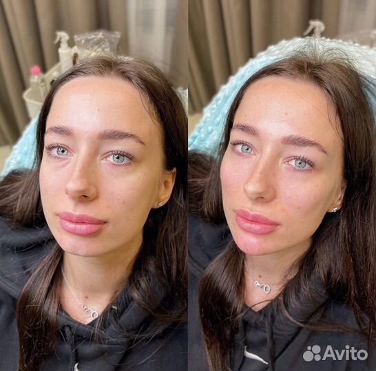 Full face омоложение