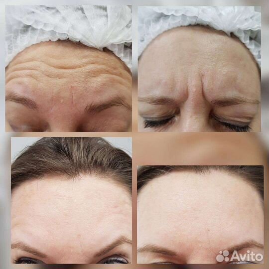 Ботокс верхняя треть