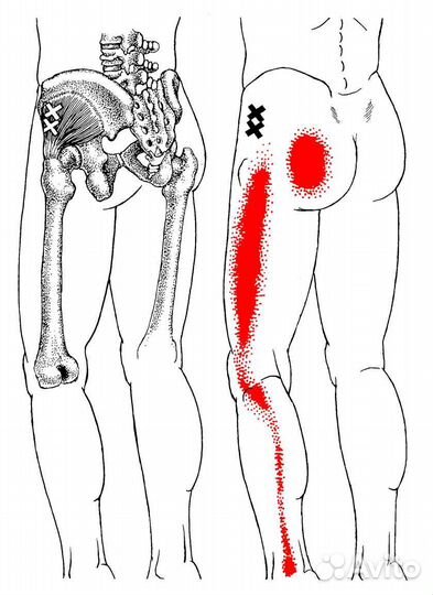 Миопрессура, работа с триггерами