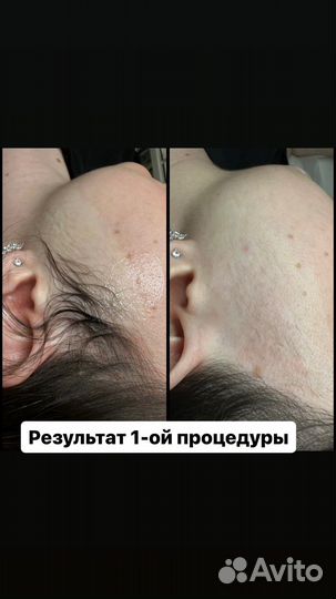 Электроэпиляция Apilus