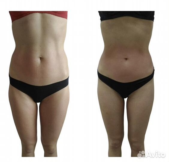 Антицеллюлитный массаж, lpg, похудение, эпиляция л