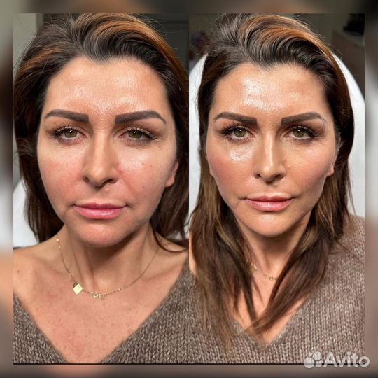 Безоперационная подтяжка лица