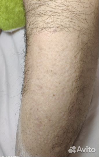 Электроэпиляция: бёдра