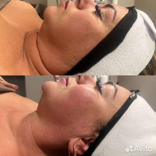 Омоложение кожи лица