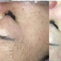 Косметолог чистка лица