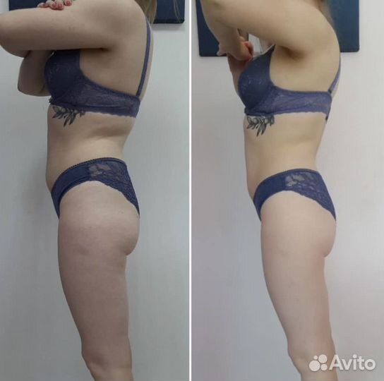 Аппаратный массаж turbo