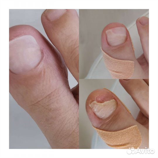 Медицинский педикюр, маникюр, наращивание