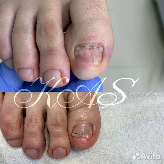 Вросший ноготь, медицинский педикюр, подолог