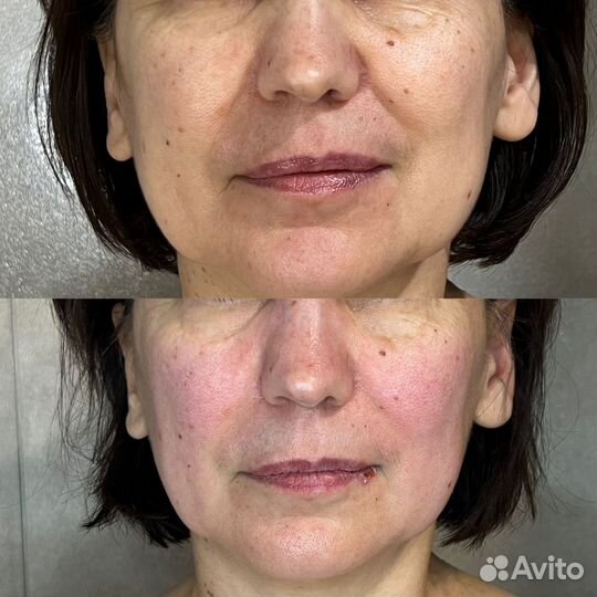 Глубокотканный массаж лица