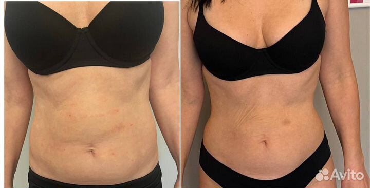 Похудение липолитиками