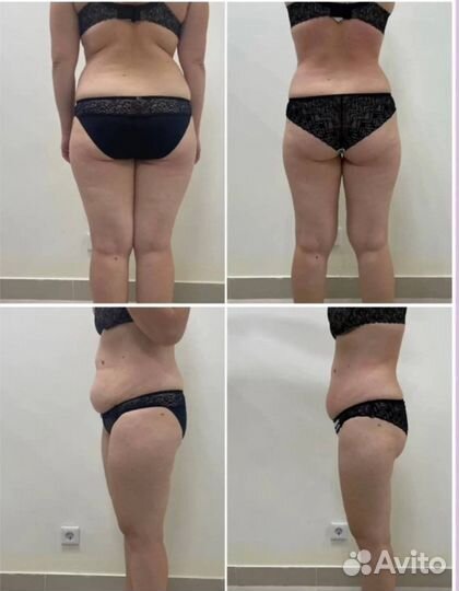 Криолиполиз,lpg массаж, кавитация,RF лифтинг