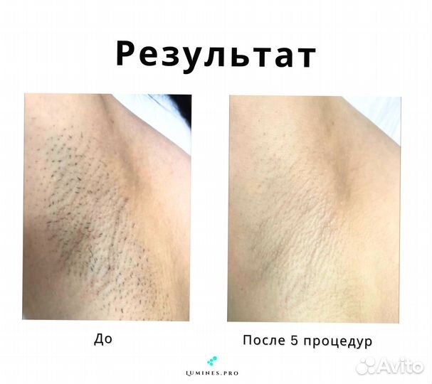 Диодный лазер для эпиляции Lumines-M Макс’Ван 1200в