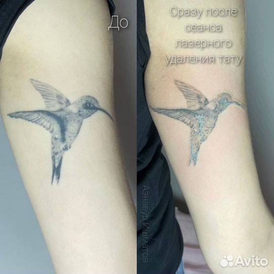 Лазерное удаление тату