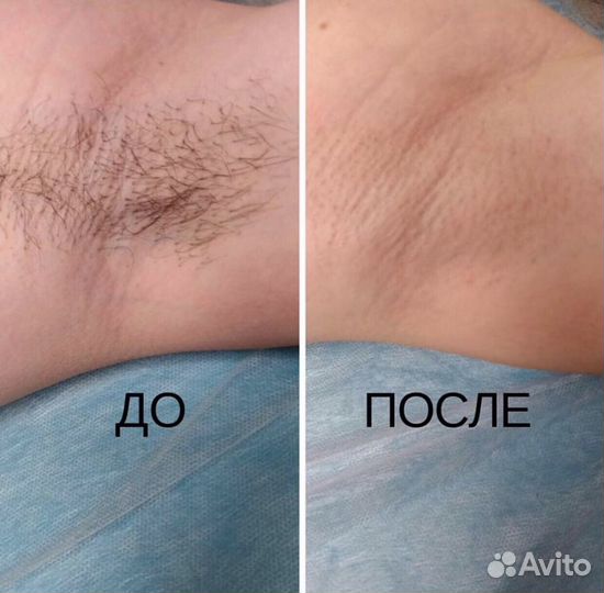 Лазерная эпиляция: подмышки