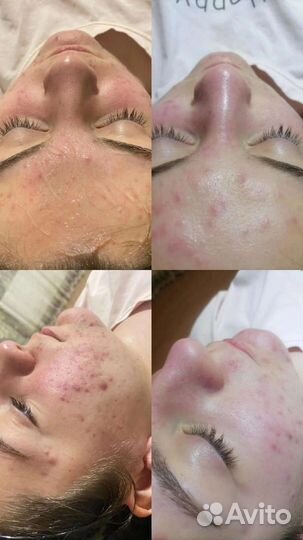 Чистка лица