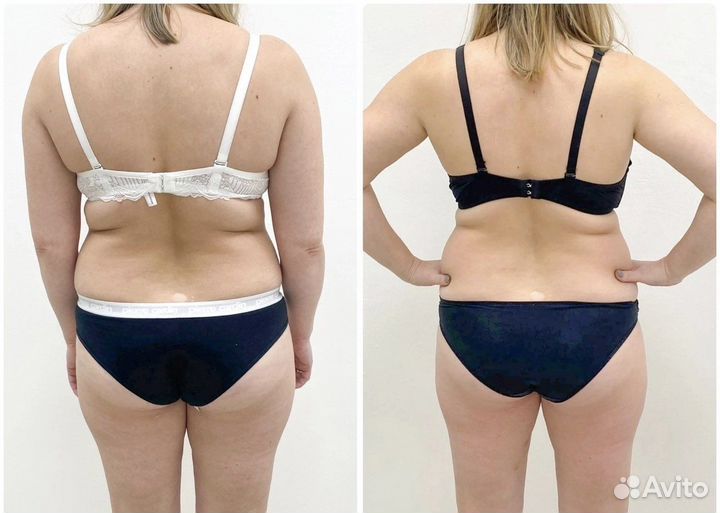 Коррекция фигуры, Вакуум, RF лифтинг, кавитация