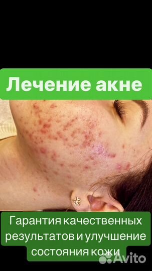 Лечение угревой болезни