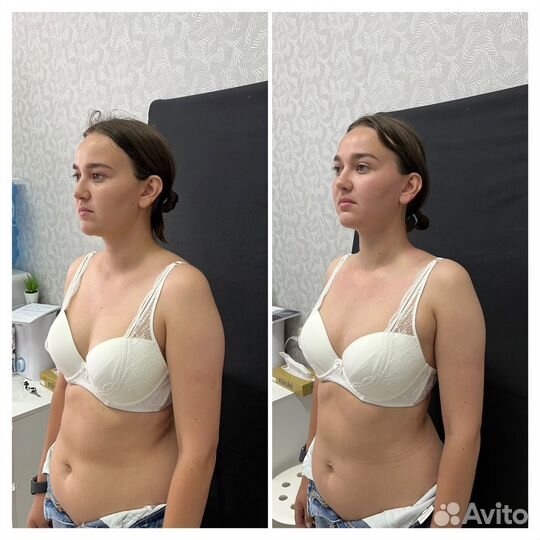 Массаж. Мадеротерапия.Ручная Липопластика