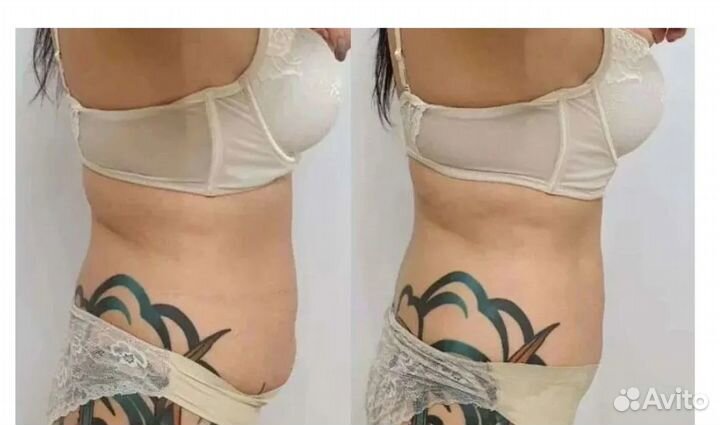 Криолиполиз в Самаре