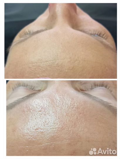 Косметолог чистка лица,пилинг