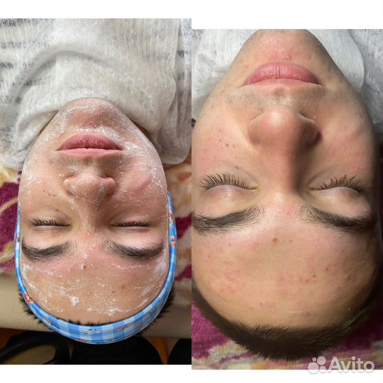 Косметолог брови чистка пилинг дермопен