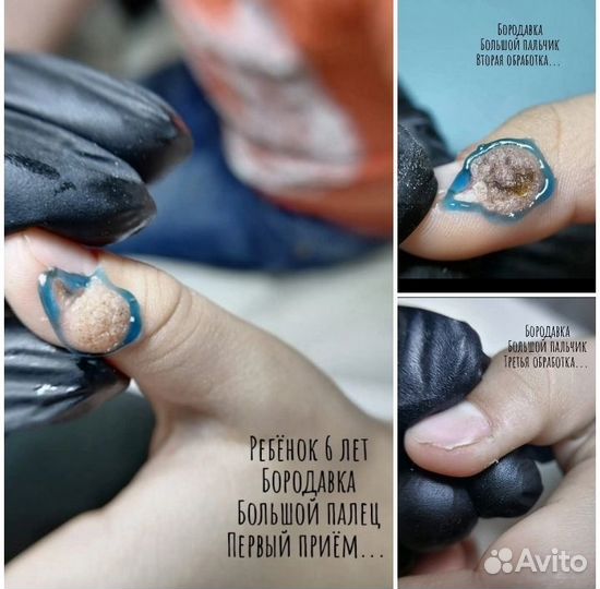 Вросший ноготь, Подология, Педикюр