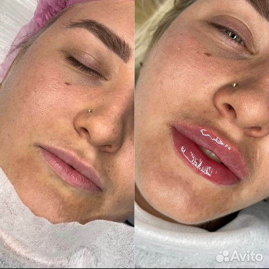 Увеличение губ