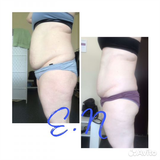 Коррекция фигуры