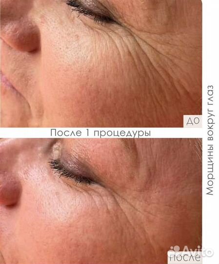 Пептидный пилинг dermaquest - набор на 4 процедуры