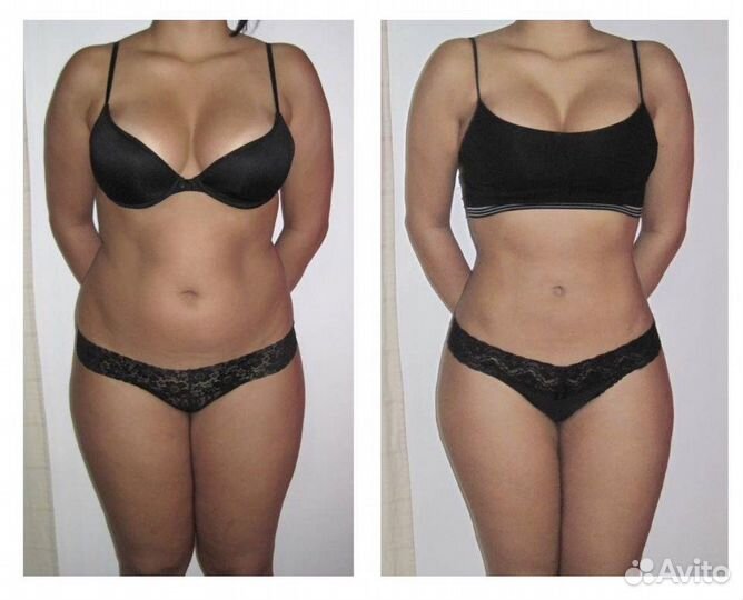 Липосакция без операции. Liposonix