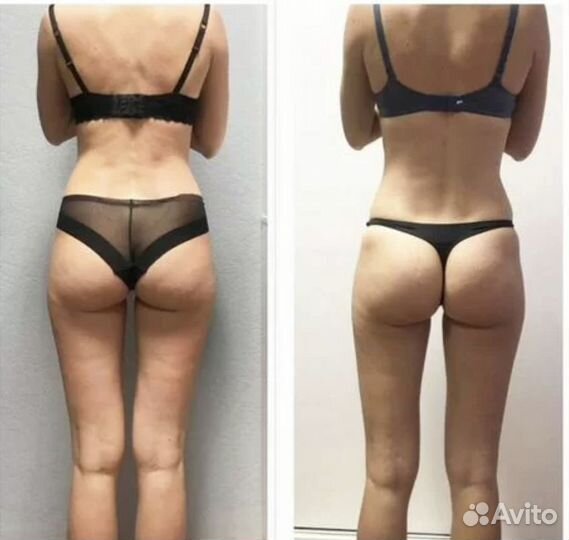 Коррекция целлюлита и жира, лифтинг кожи. акция