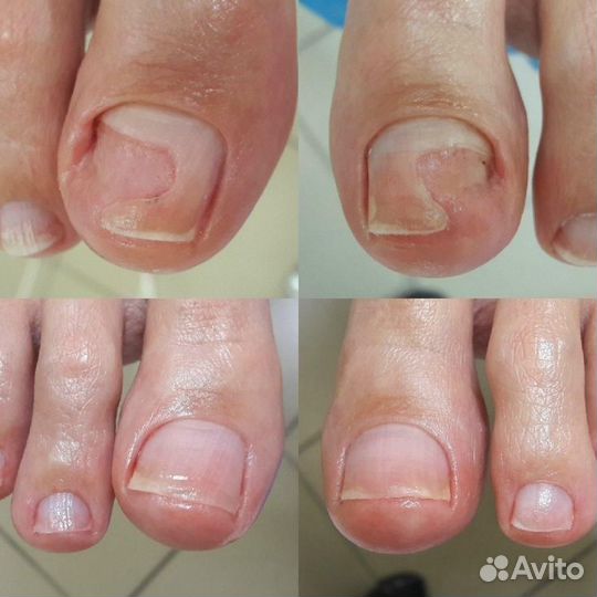 Подолог Педикюр Вросший ноготь Онихолизис