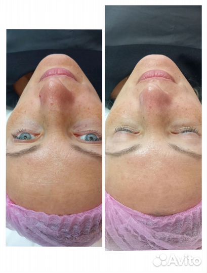 Косметолог чистка лица,пилинг