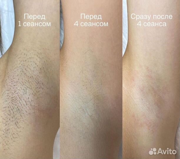 Лазерная эпиляция.Все тело