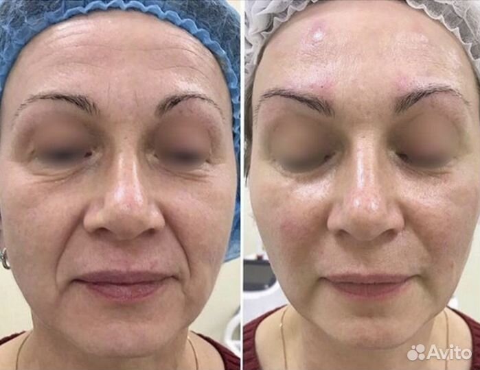 Модель на RF-Лифтинг (абсолютно бесплатно)