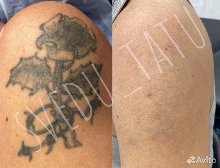 Лазерное удаление татуировок и татуажа Пирсинг