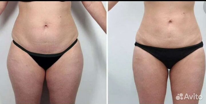 Липосакция, жиротоп и похудение Липосоникс