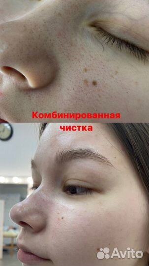 Чистка лица комплексная