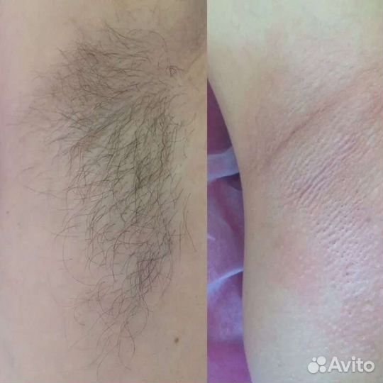 Депиляция